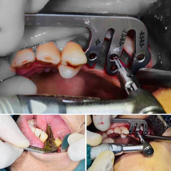 IMPLANT POSITIONING DETECTORS - Image 4