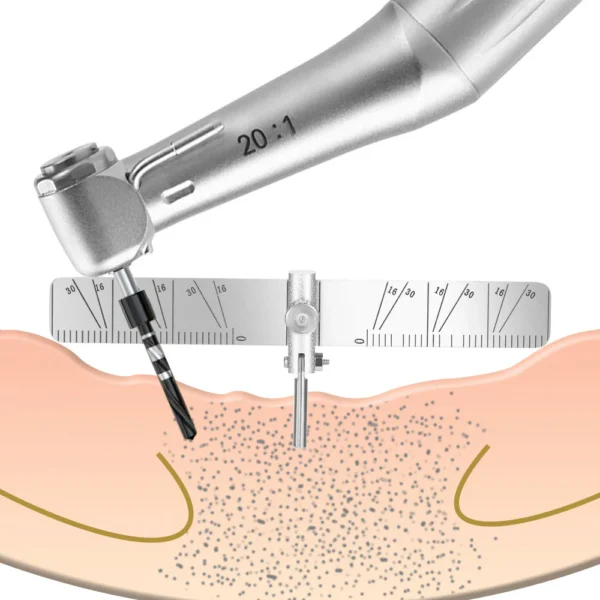 All On 4 Dental Implants Locating Guide - Image 2