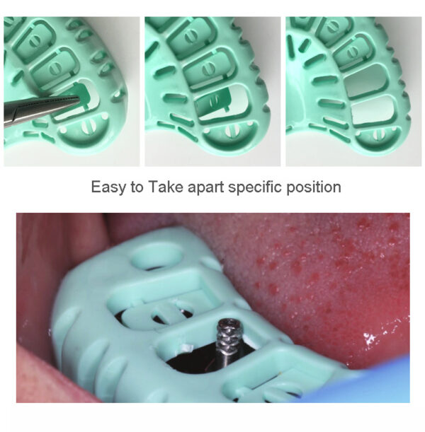 JEFIX - Dental Implant Impression Trays - Image 5