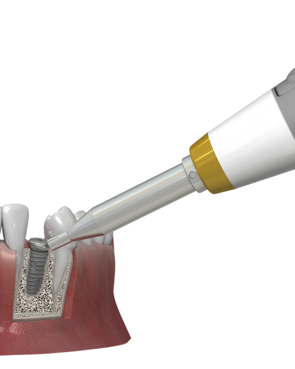 Implant Stability Meter - Image 3