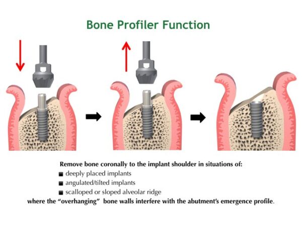 Crestal Bone Profiler - Image 6