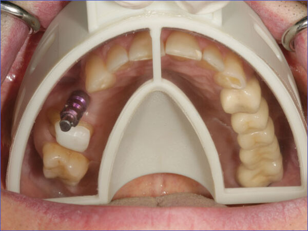 JEFIX - Dental Implant Impression Trays - Image 3