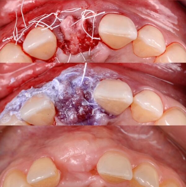 CYANO-ACRYLATE Tissue Adhesive - Image 4